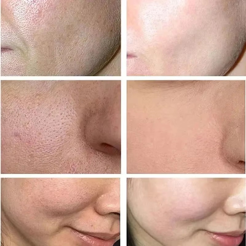 Salicylic Acid Pore Shrinking  - Skincare Salicylic Acid review and price